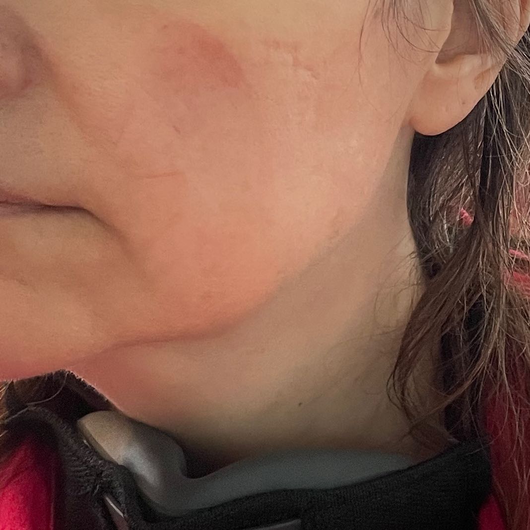 Close up of red marks on lady's face
